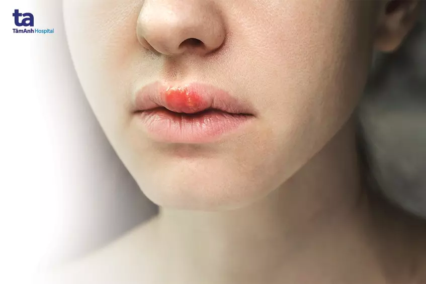 Hình ảnh minh hoạ mụn rộp do herpes