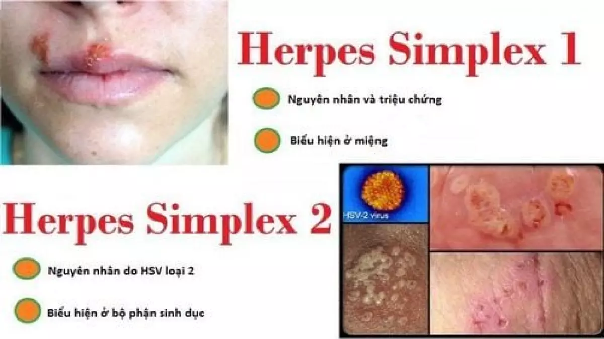 Virus Herpes Simplex gây mụn rộp sinh dục ở các vị trí khác nhau