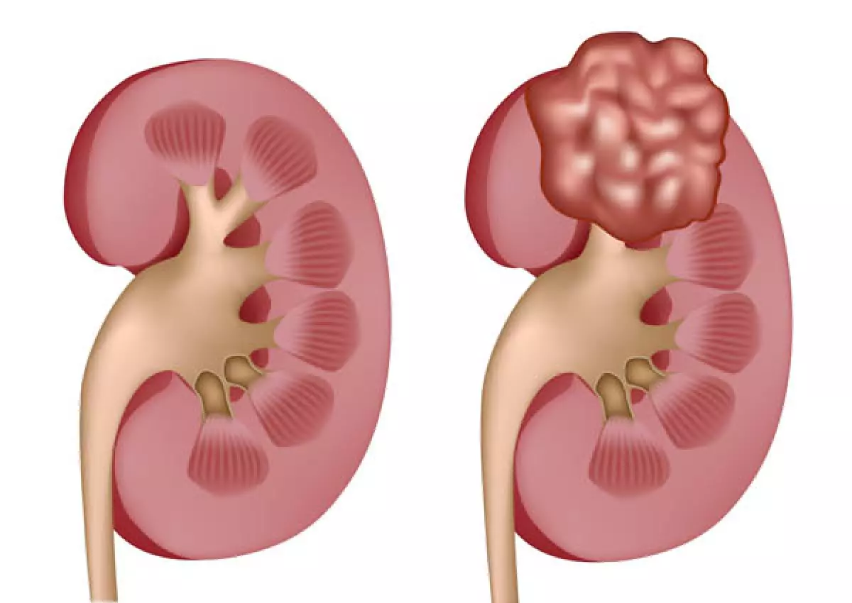 Hình ảnh minh họa tế bào carcinoma và căn bệnh ung thư