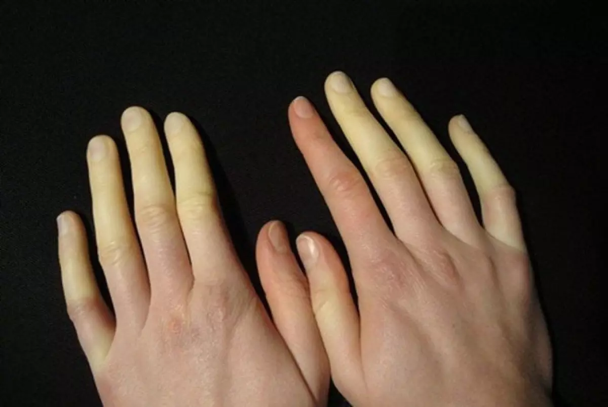 Hội chứng Raynaud: Co thắt động mạch giảm lưu lượng máu đến mô