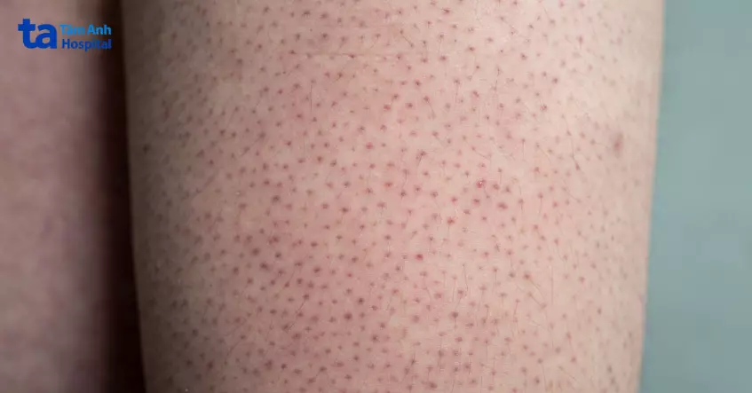 Dày sừng nang lông (Keratosis pilaris) là bệnh ở da, gây sẩn sừng, làm bề mặt da thô ráp