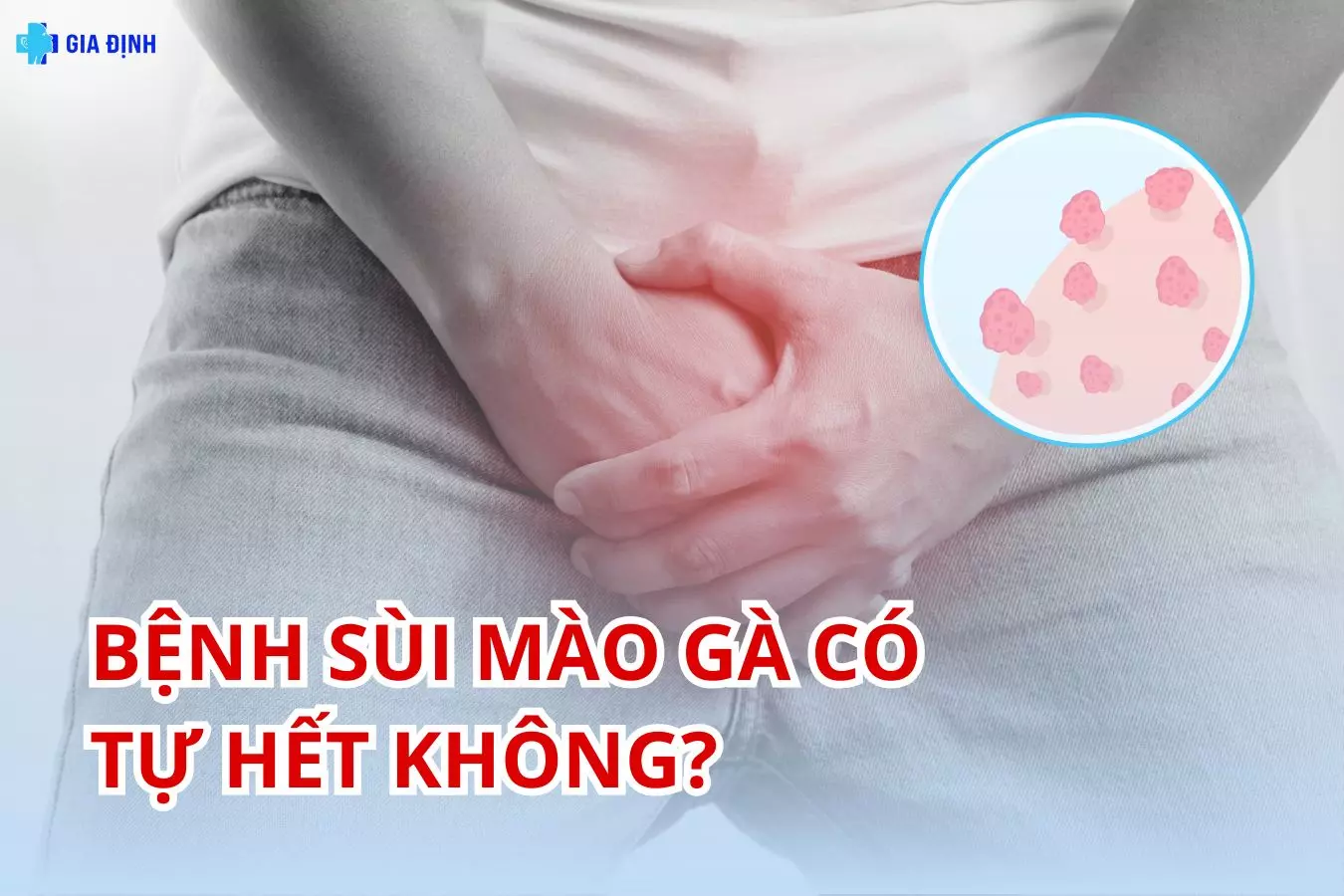 Sùi mào gà có tự hết không?